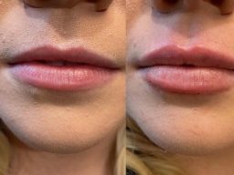 dermal fillers