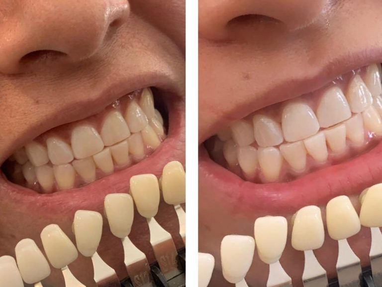 Laser Teeth Whitening Gloucestershire