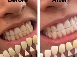 Teeth whitening Cotswolds