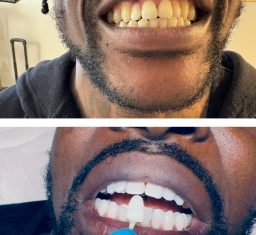 microneedling