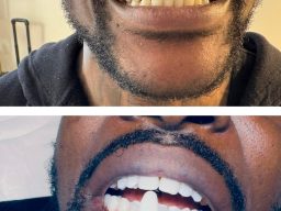 Aesthetics clinic Cheltenham, Beauty salon Cheltenham, Cosmetic treatments Cheltenham, Skin clinic Cheltenham, Facial treatments Cheltenham, micro-needling in Cheltenham