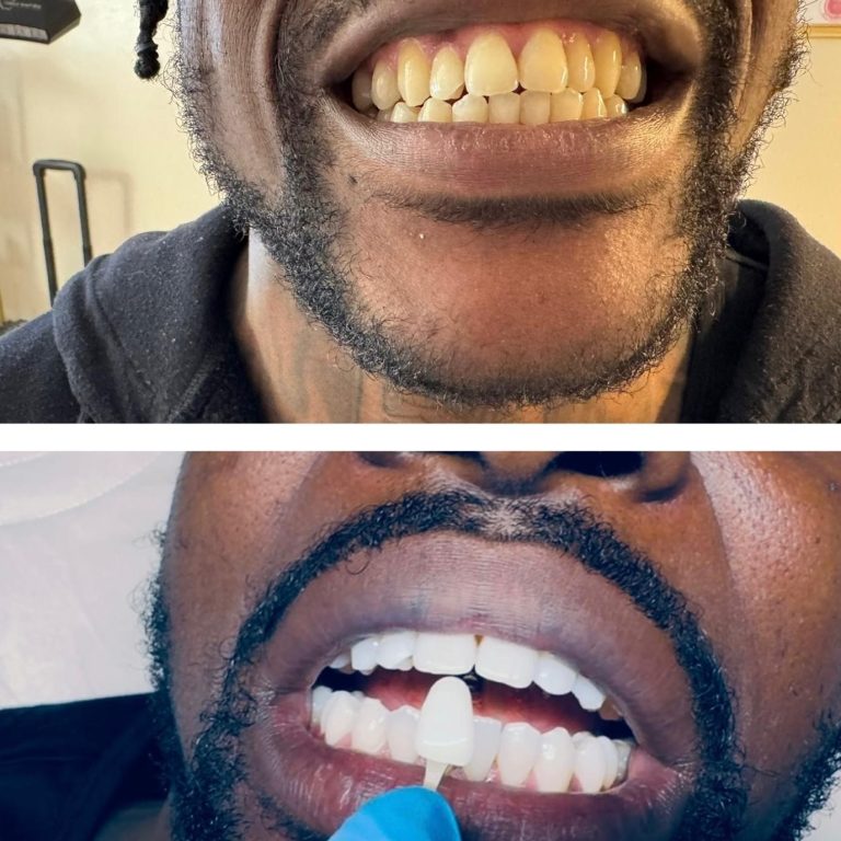 Laser Teeth Whitening Cheltenham