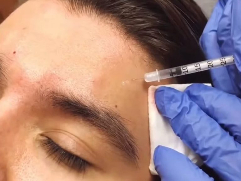Botox injections