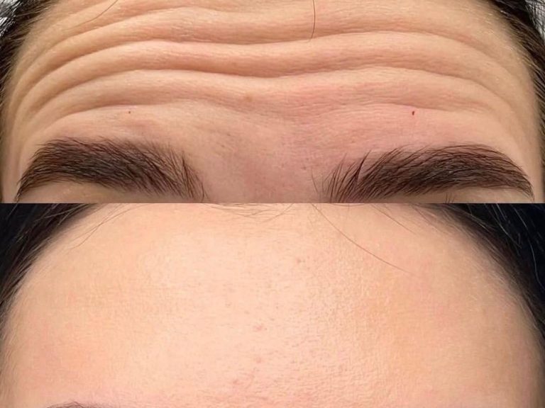 Botox in Gloucestershire