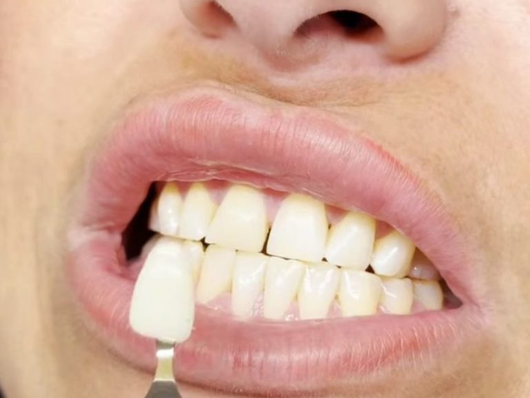 Teeth whitening Cheltenham