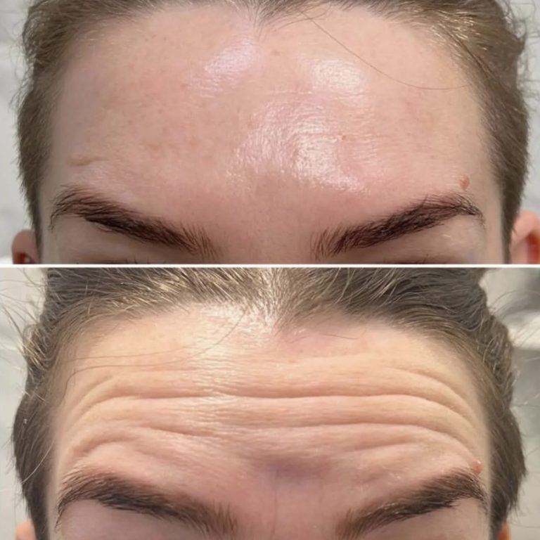 Botox Cheltenham