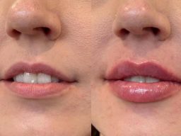 fillers cheltenham