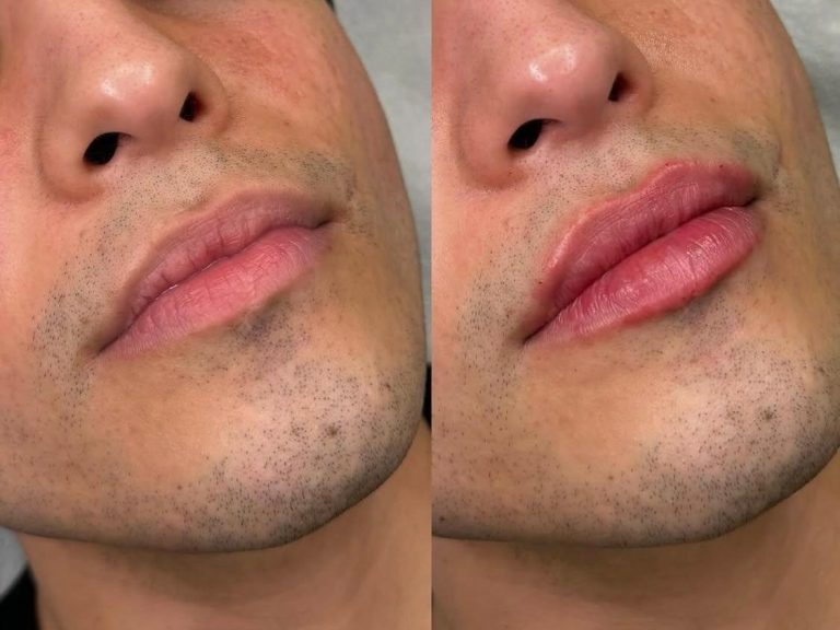 Derma Lip Fillers Cheltenham