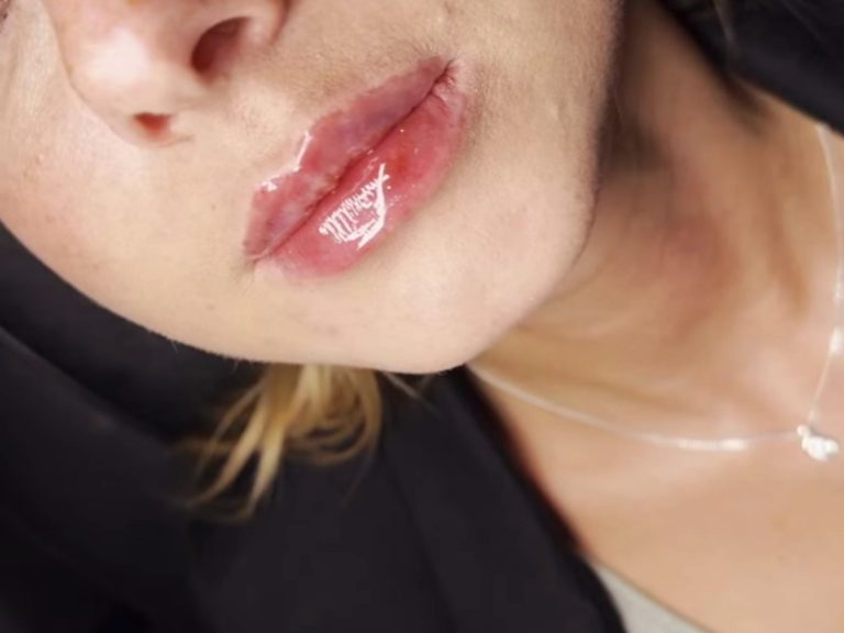 lip fillers cheltenham