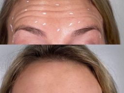 anti-wrinkle injections