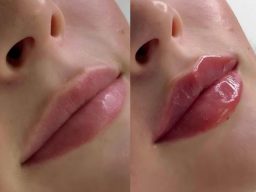 filler injections cheltenham