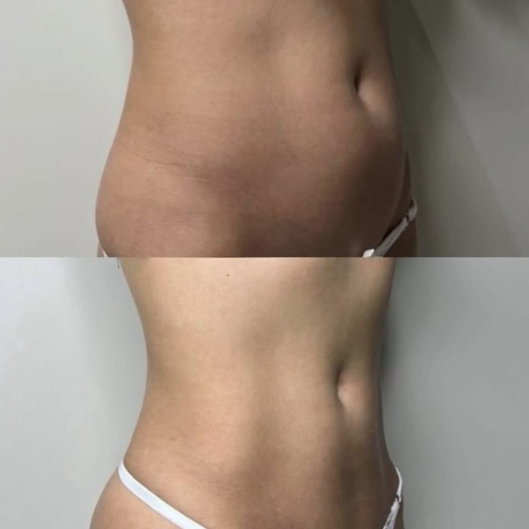 Fat dissolving injections cheltenham